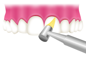 PMTC　歯と歯の隙間を清掃